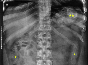 Wielka Brytania: skazano mężczyznę przemycającego ponad kilogram kokainy w żołądku