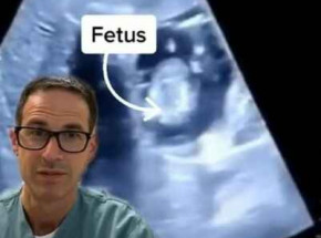 Kanada: zidentyfikowano ciążę pozamaciczną w wątrobie