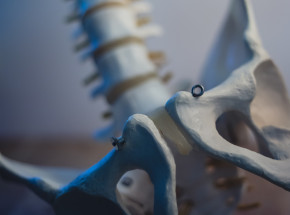 Gliwice: usunięto 3-kilogramowy nowotwór kości miednicy i wszczepiono implant 3D 