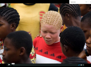 Tanzania: coraz więcej ataków na osoby dotknięte albinizmem 