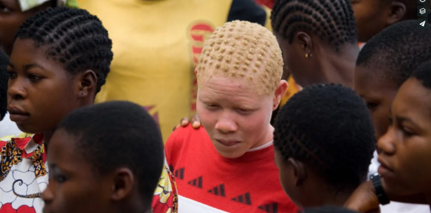 Tanzania: coraz więcej ataków na osoby dotknięte albinizmem 
